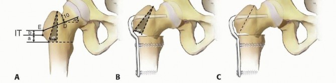 Illustration 6 for Proximal Femoral Osteotomy: When This Hip-Saving Surgery Is Performed