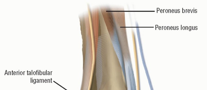 Restore Ankle Stability: The Essential Repair of Lateral Ligaments