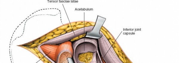 Illustration 124 for Unlocking Every Aspect of the Hip's Surgical Approaches