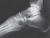 Illustration 21 for Talar Neck Fracture Treatment: Optimizing Recovery with ORIF