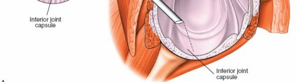 Illustration 240 for Essential Guide: Mastering Every Approach to the Shoulder