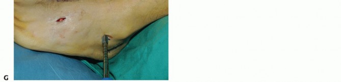 Illustration 81 for Mastering Midfoot Arthrodesis: Protect the Deep Neurovascular Bundle