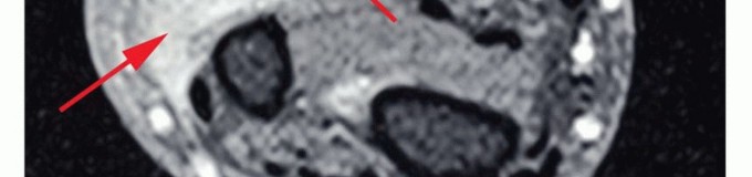 Illustration 14 for Above-Elbow & Below-Elbow Amputations: When & Why They're Needed