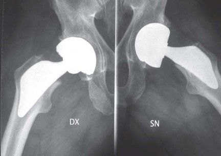 Illustration 25 for The Proxima: Why This Proximally Loading Implant Preserves Bone