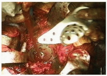 Illustration 12 for Uncemented Acetabular Component: Augments & Cup-Cages for Bone Loss