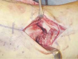 Illustration 12 for Talar Neck Fracture Treatment: Optimizing Recovery with ORIF