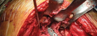 Illustration 30 for Optimizing Arthroplasty in Acute Fractures: Octopus System