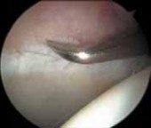 Illustration 36 for Solving Hip Soft Tissue Pathology with Advanced Arthroscopy