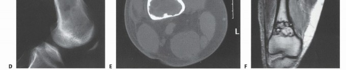 Illustration 21 for Understanding Benign Bone Tumors: Your Complete Preoperative Guide
