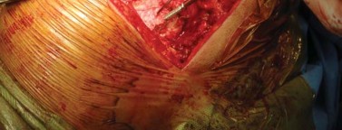 Illustration 19 for Optimizing Arthroplasty in Acute Fractures: Octopus System