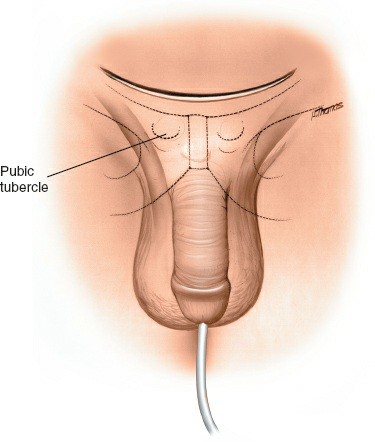 Anterior Approach to Pubic Symphysis: Surgical Anatomy, Biomechanics & Fixation