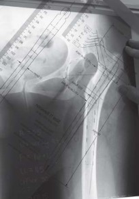 Illustration 32 for Successful Total Hip Replacement in Developmental Dysplasia