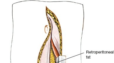 Illustration 88 for Approach to the Lumbar Spine: Mastering Techniques & Anatomy