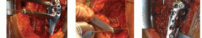 Illustration 21 for Optimizing Fixation of Proximal Humerus Fractures: A Guide