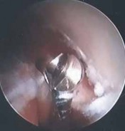 Illustration 10 for Unlock Relief: Arthroscopic Treatment of Epicondylitis Explained