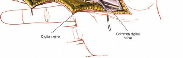 Illustration 150 for Essential Surgical Approaches: Uncover Every Aspect of the Wrist