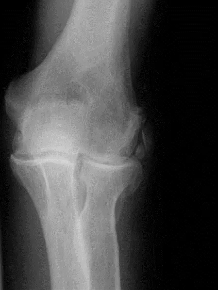 خشونة مفصل المرفق: دليل شامل للتشخيص والعلاج مع الأستاذ الدكتور محمد هطيف في صنعاء