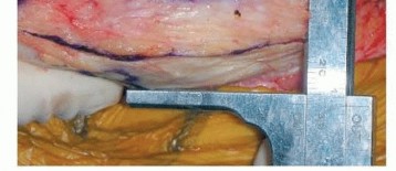 Illustration 15 for Correcting Stiffness in Revision TKA: Achieve Appropriate External Rotation