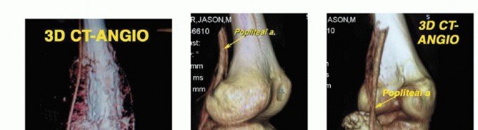 Illustration 17 for Advanced Distal Femoral Resections: Limb-Sparing Outcomes & Techniques