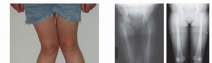 Illustration 3 for Optimizing Growth to Correct Pediatric Limb Deformities