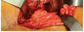 صورة توضيحية لـ استبدال مفصل الورك الكلي: النهج الخلفي الجانبي الموسع والتدخلي المحدود