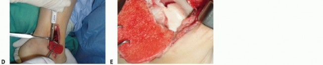 Illustration 19 for Painful Talus Lesions? The tech fig c Osteochondral Transfer Solution