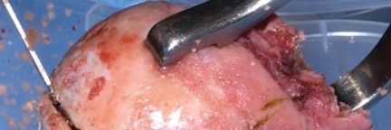 Illustration 60 for Navigating Early THA for Fractures of the Acetabulum