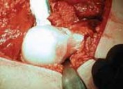 Illustration 21 for FAI: Impingement and Surgical Dislocation Explained