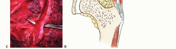 Illustration 51 for Pelvic Metastasis Surgery: A Component of the Utilitarian Approach