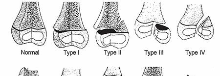 Mastering Pediatric Fractures and Dislocations: Essential Principles