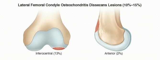 Illustration 5 for Dissecans of the Knee: What's the Difference – OCD vs. AVN?