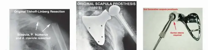 الاستئصال الكلي للوح الكتف: دليل شامل للمرضى حول الجراحة، إعادة البناء والنتائج مع الأستاذ الدكتور محمد هطيف في صنعاء