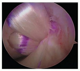 Illustration 19 for Posterior Cruciate Ligament Surgery: Regain Knee Strength & Stability