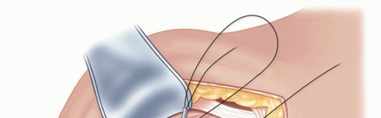 Illustration 15 for Irreparable Subscapularis Tears? Explore Pectoralis Major Transfer.