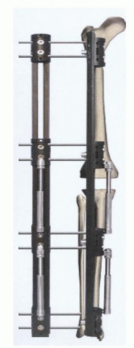 Illustration 7 for Knee Arthrodesis: A Solution for Stable Femur & Tibia Fusion