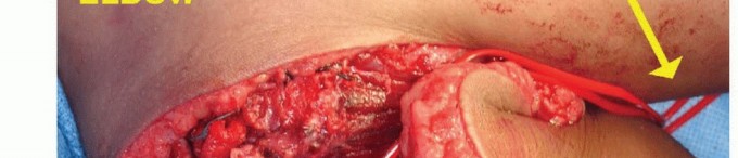 Illustration 25 for Distal Humeral Resection: Safe Techniques for Limb Preservation