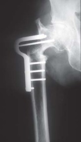 Illustration 48 for S-ROM: Inside the Technique of Modular Implant Design
