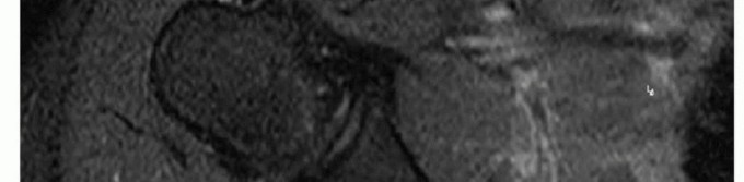 Illustration 9 for Is Your Dorsal Scapular Nerve Causing Snapping Scapula Pain?