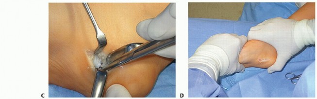 Illustration 16 for How Achilles Tendon Lengthening Fixes Equinocavovarus Foot