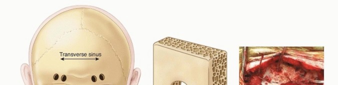 Illustration 22 for Addressing Cervical Spine Instability with Posterior Arthrodesis
