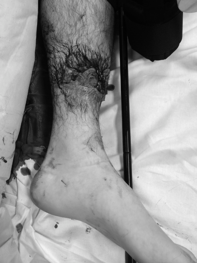 High-Energy Midshaft Diaphyseal Tibia Fracture: A Trauma Approach