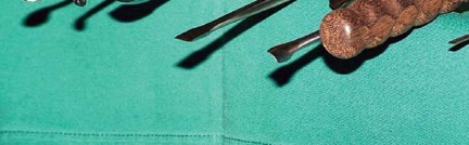 Illustration 26 for Optimizing Infected THA: The One Staged Approach Explained