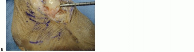 Illustration 10 for Lateral Ankle Repair: Maximize Stability with Interference Screw Fixation