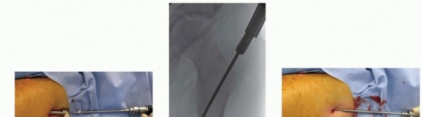Illustration 13 for Pediatric Femoral Nailing: Targeting the Right aspect of the greater Trochanter