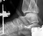 Illustration 8 for Decoding Pilon Fractures: Anterolateral and Medial Fragments Revealed