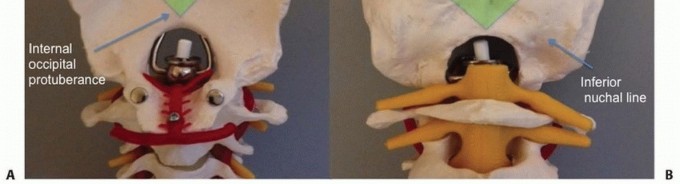 Illustration 5 for Addressing Cervical Spine Instability with Posterior Arthrodesis