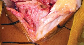 Illustration 5 for Monoblock Total Knee: When to Use & What to Avoid