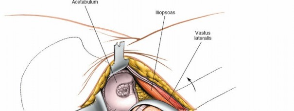 Illustration 142 for Unlocking Every Aspect of the Hip's Surgical Approaches