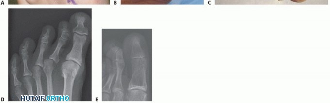 Illustration 2 for Toe Deformity Pain? Rebalance Flexor to Extensor for Relief