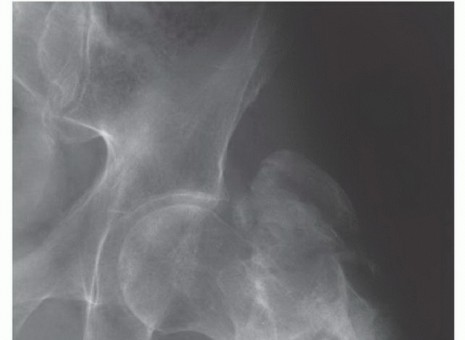 Illustration 12 for Beyond Amputation: Total Femur Resection with Endoprosthetics